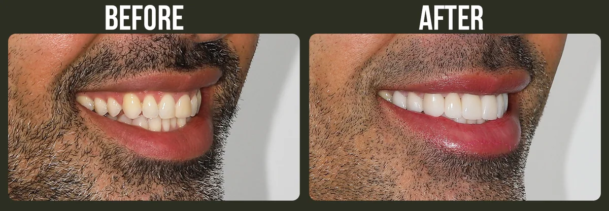 Before and after veneers — a real Horizon Dental patient result