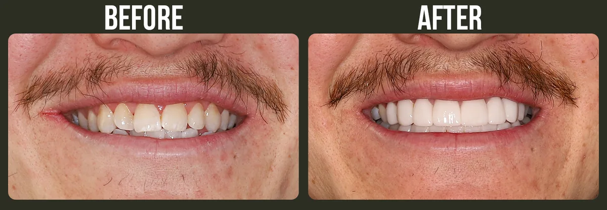 Before and after veneers — Horizon Dental patient