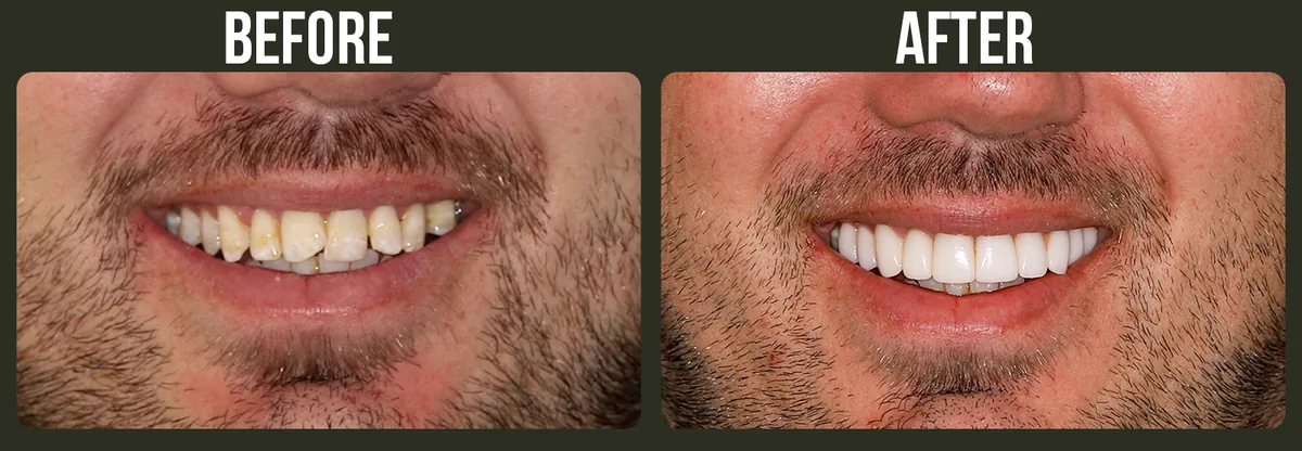 Before and after veneers — Horizon Dental patient