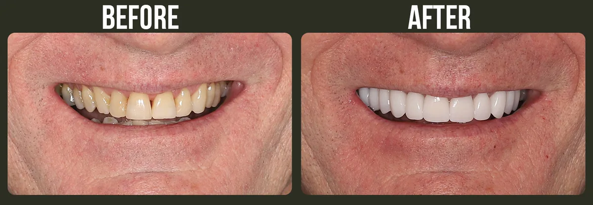 Before and after veneers — Horizon Dental patient