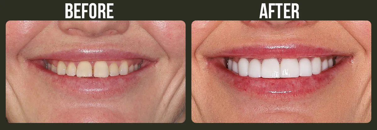 Before and after veneers — Horizon Dental patient