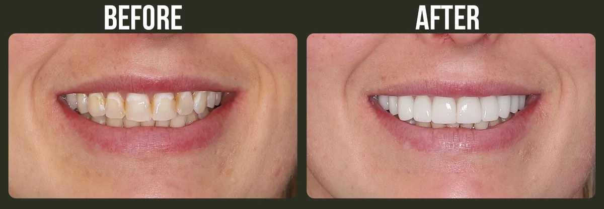 Before and after veneers — Horizon Dental patient