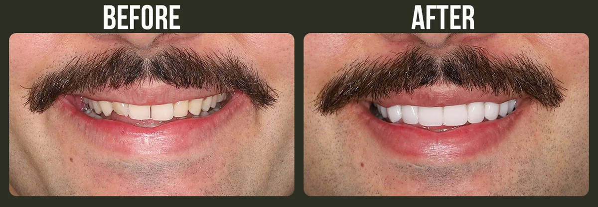 Before and after veneers — Horizon Dental patient
