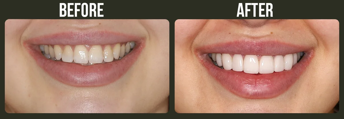 Before and after veneers — Horizon Dental patient