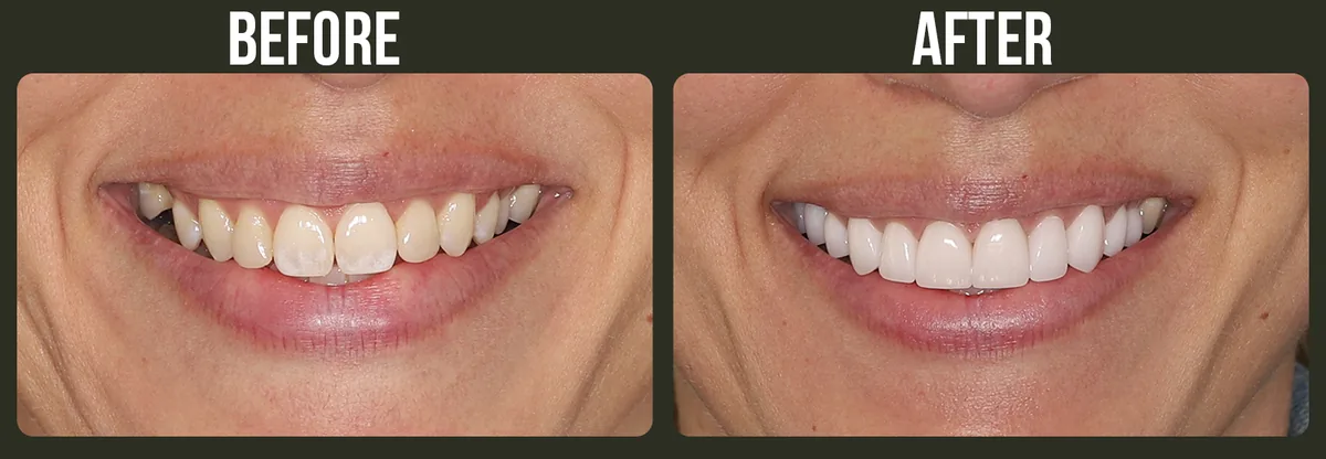 Before and after veneers — Horizon Dental patient