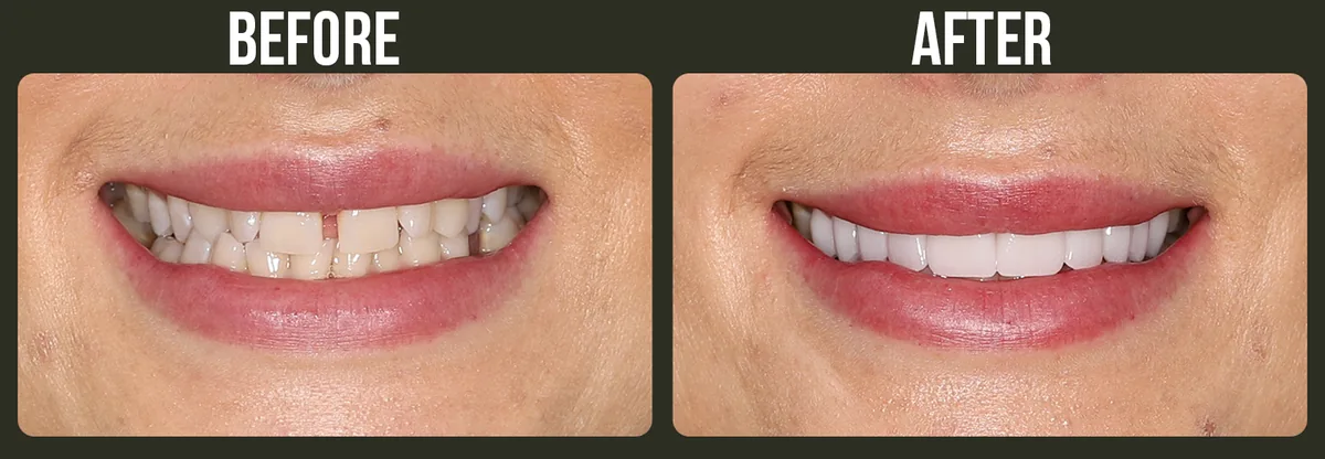 Before and after veneers — Horizon Dental patient